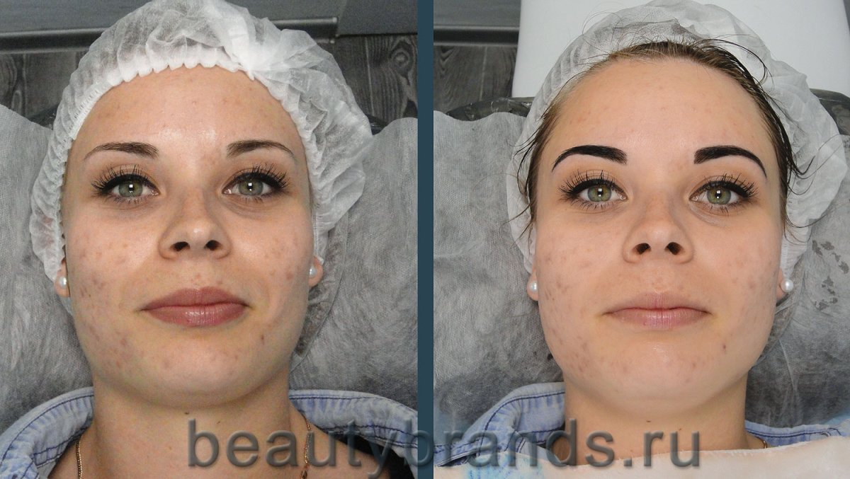 Карбоновый пилинг для лица до и после