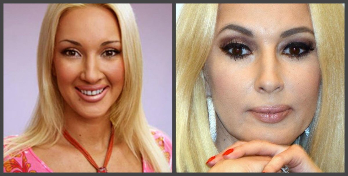 Лера Кудрявцева ринопластика