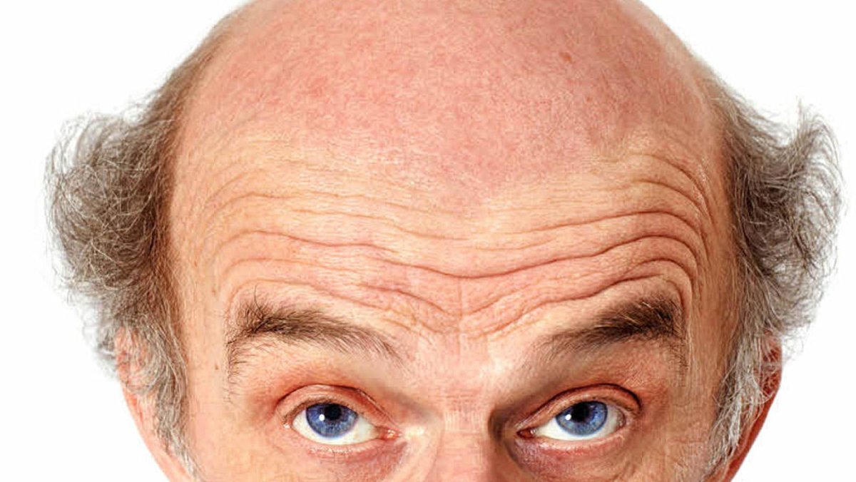 Лысина с волосами по бокам