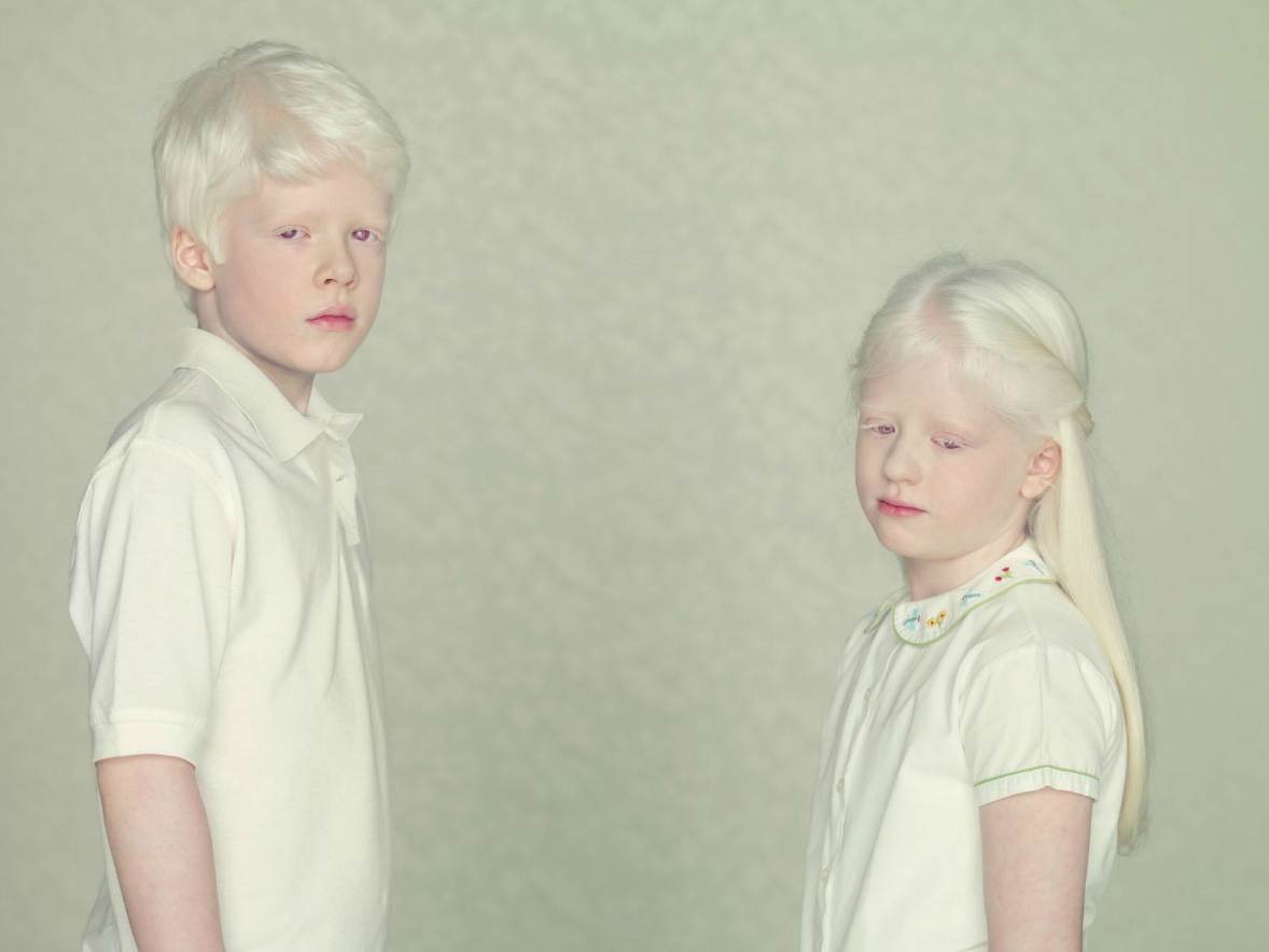 Глазокожный альбинизм Тип 1а