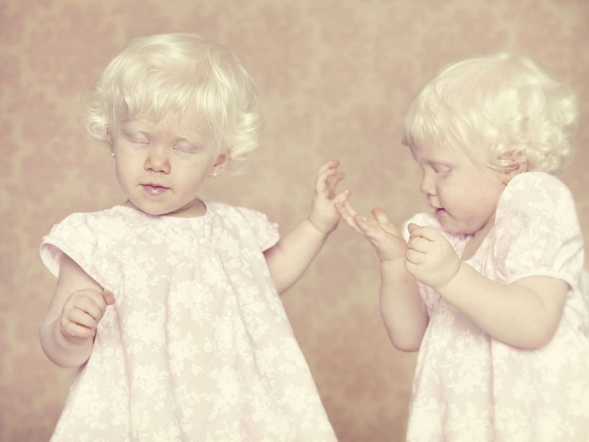 Дети альбиносы в России