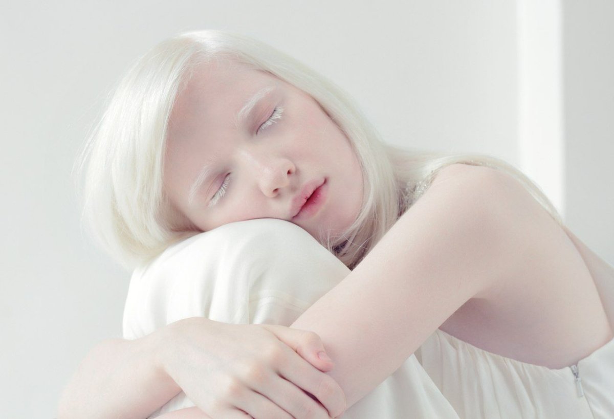 Альбинизм 1b