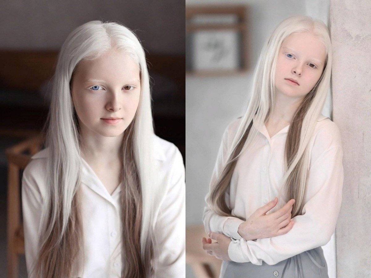 Амина Эпендиева альбинос