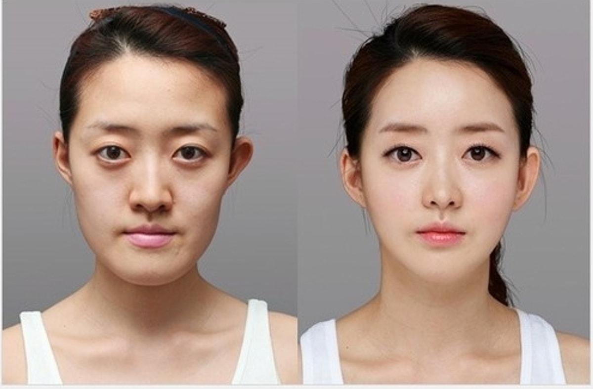 Южная Корея до и после пластики