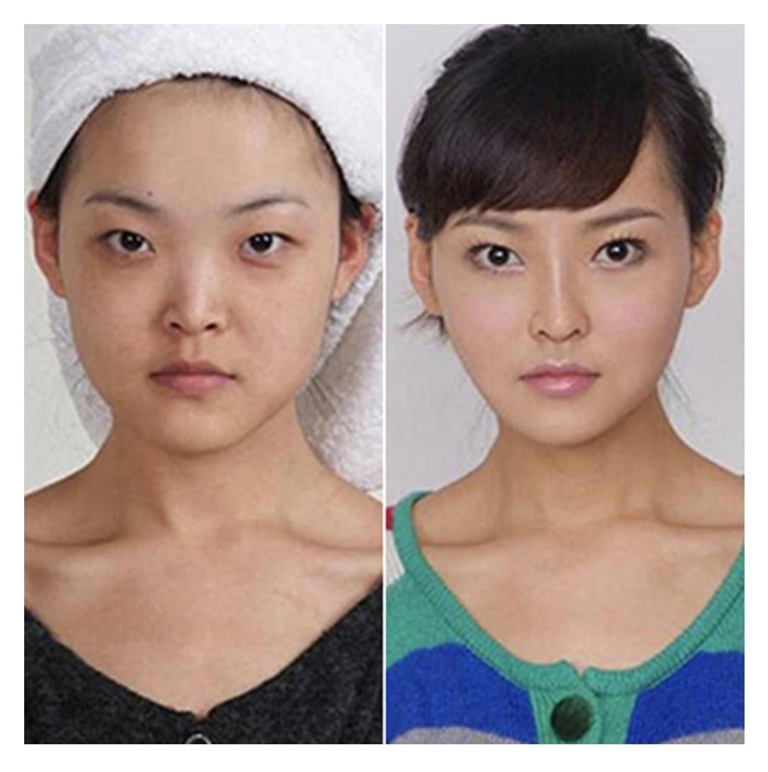 Мандибулопластика Корея