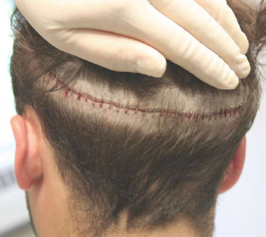 Рассечение кожи головы
