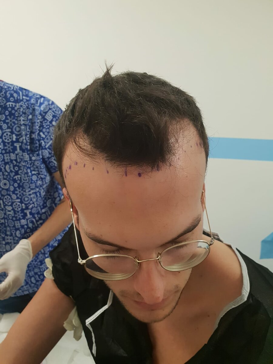 Залысины на голове