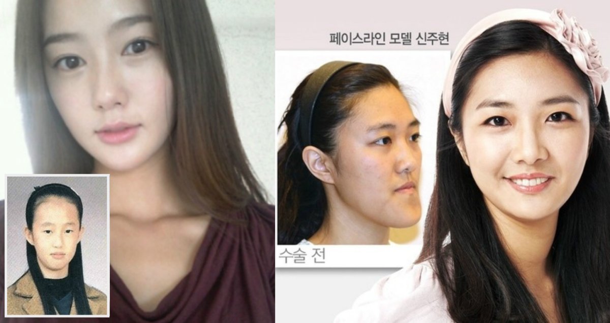 Пластика лица актеры Корея